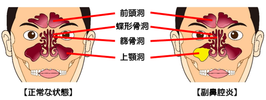風邪と副鼻腔感染症